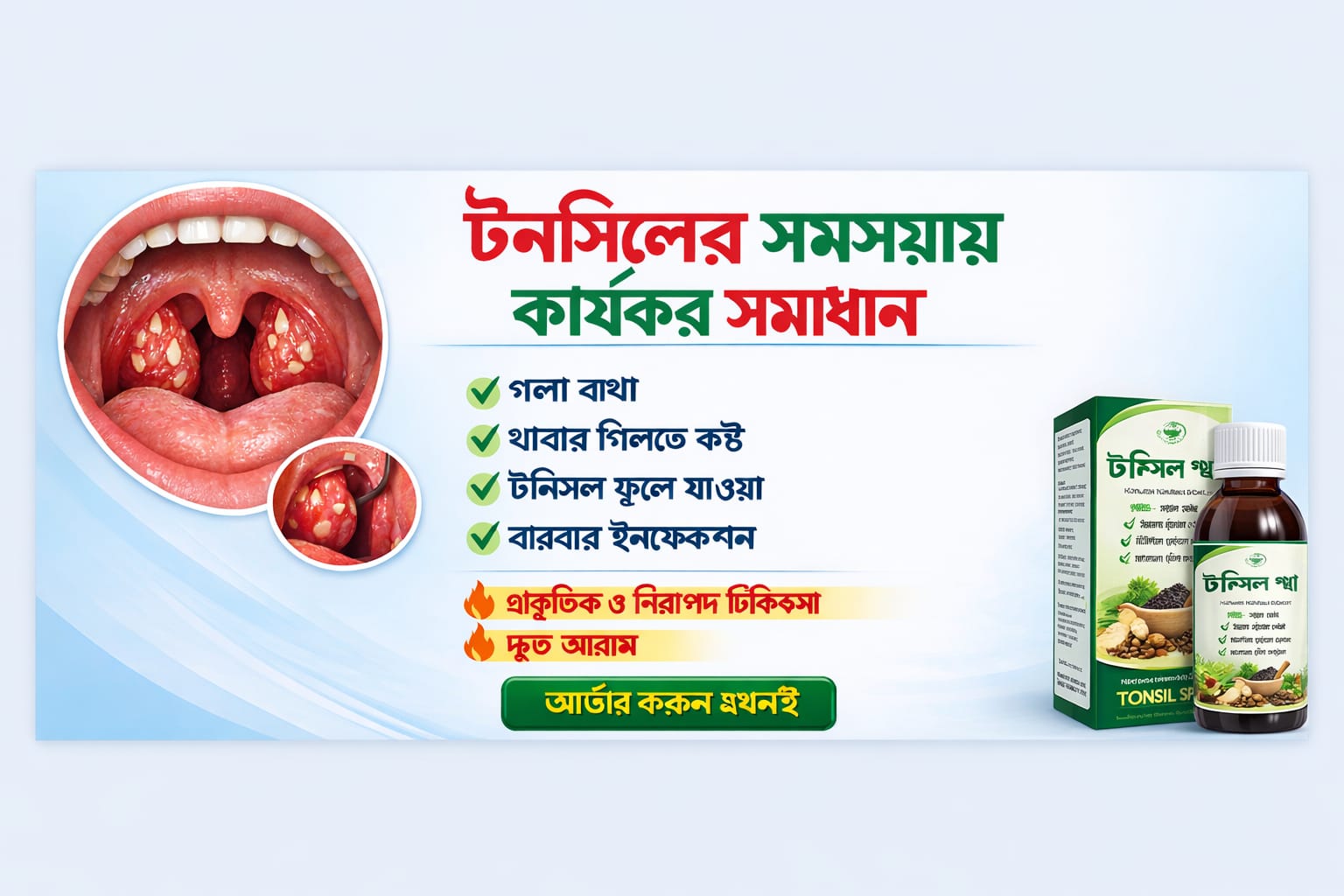 টনসিলাইটিস (Tonsillitis)